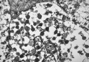 M, 49y. | pancreatic tumor (insulinoma v.s.) M, 49y. | pancreatic tumor (insulinoma v.s.)